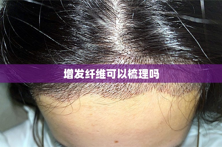 外国人如何选择专业的植发医生在西安