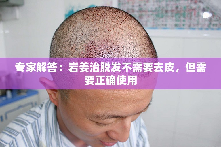 专家解答：岩姜治脱发不需要去皮，但需要正确使用