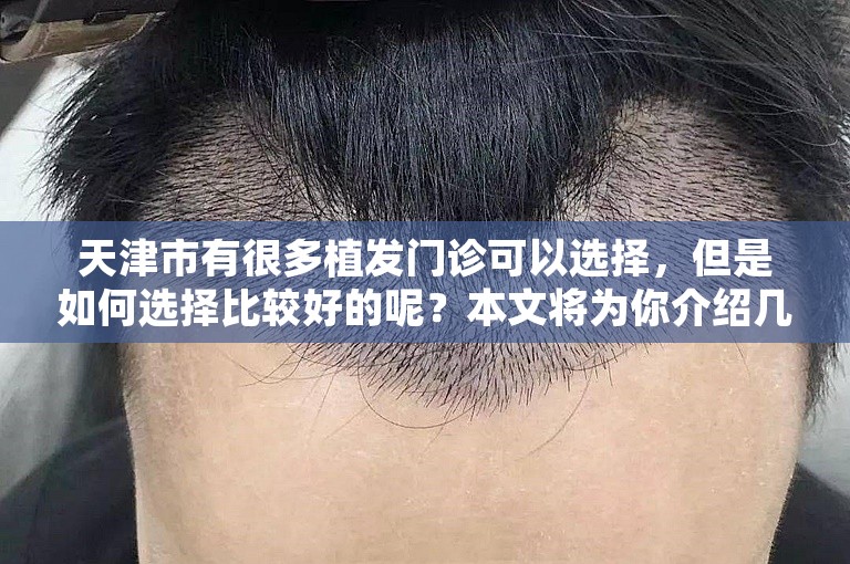 天津市有很多植发门诊可以选择，但是如何选择比较好的呢？本文将为你介绍几个较为可靠的选择方案。