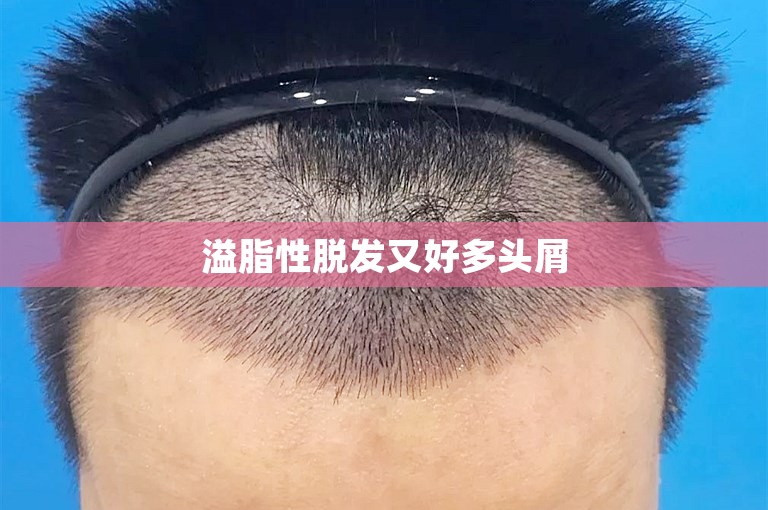 热门话题：我的植发经历——郑州知名植发专家选择方案