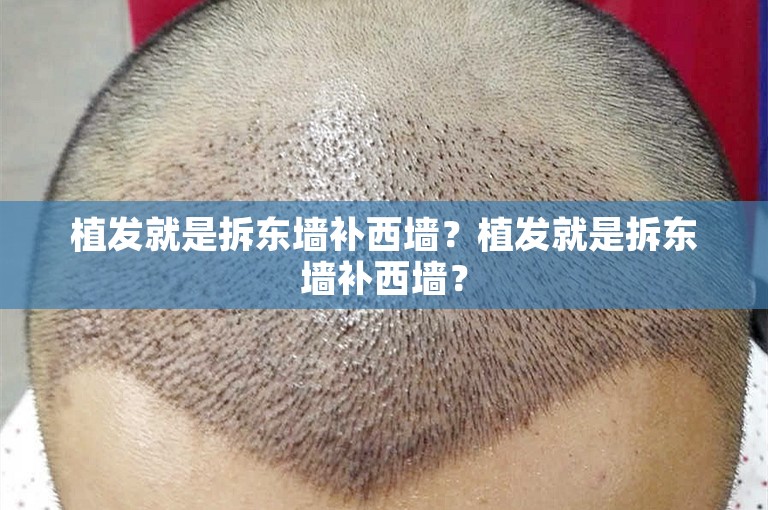 苏州植发医生选择攻略：如何挑选靠谱的头发种植专家？