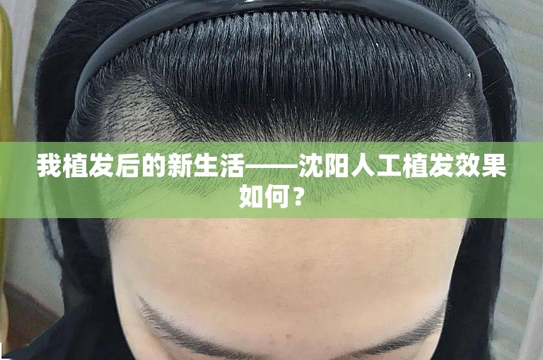 我植发后的新生活——沈阳人工植发效果如何？