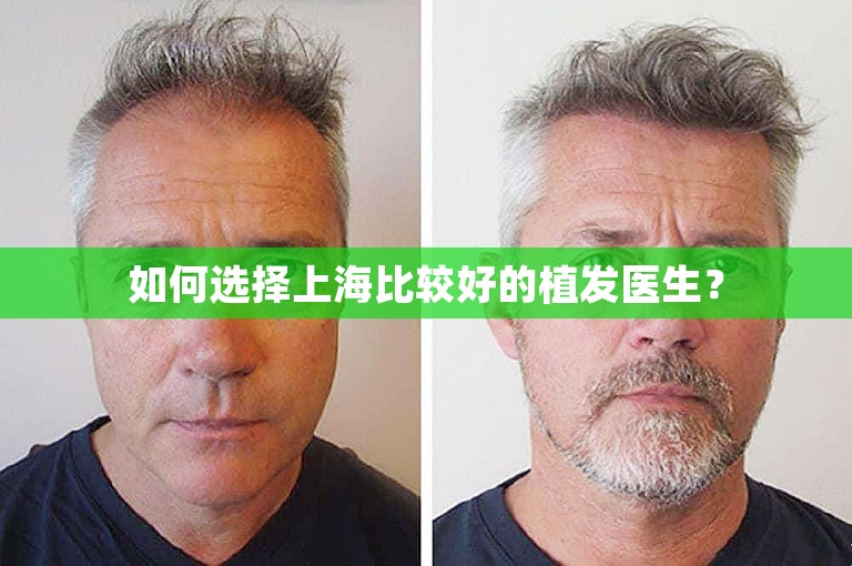 如何选择上海比较好的植发医生？