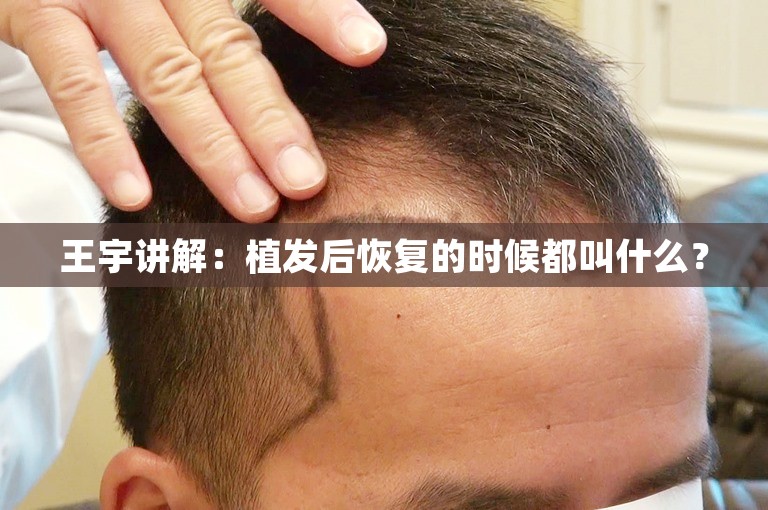 如何选择杭州技术最好的植发医生
