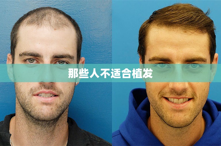 如何选择杭州比较好的植发专家？
