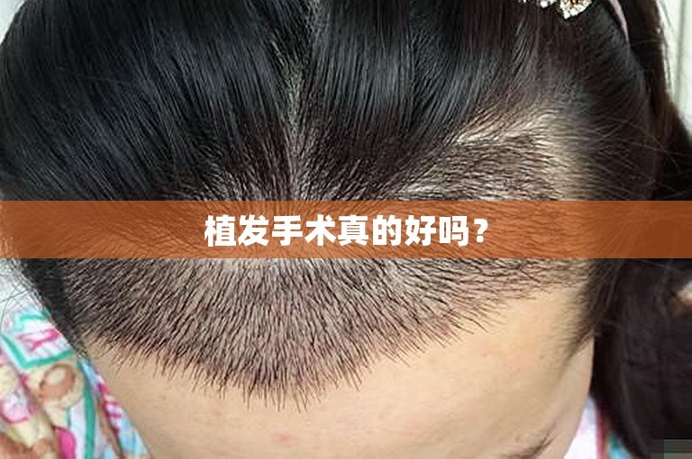 郑州头发种植好点的植发门诊选择方案