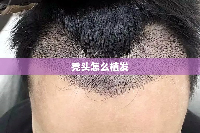 武汉的植发医生怎么选？
