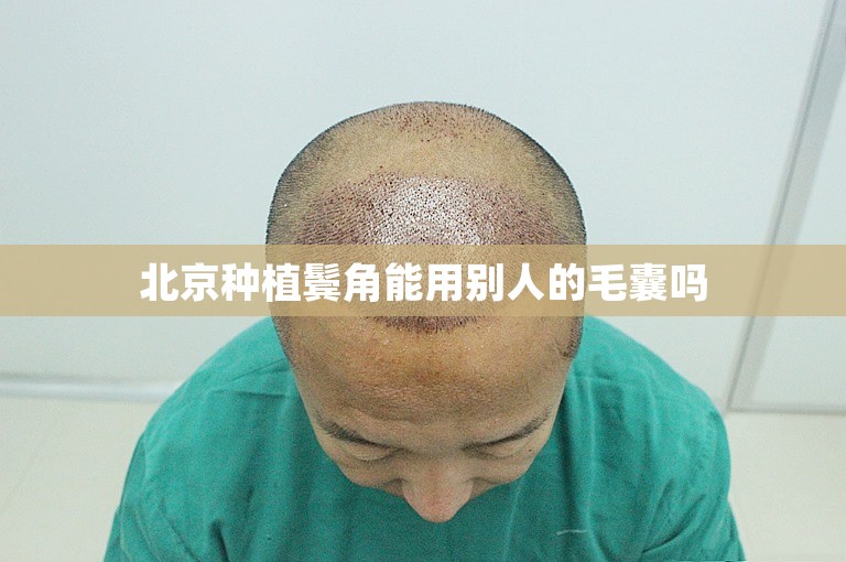 北京种植鬓角能用别人的毛囊吗