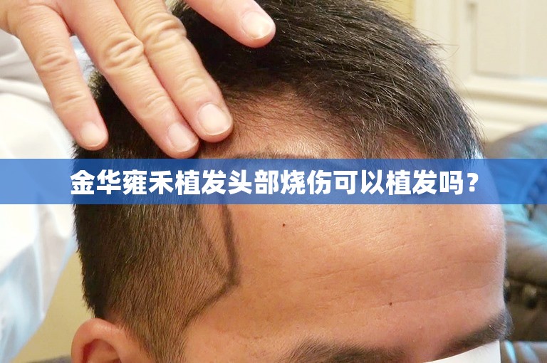 金华雍禾植发头部烧伤可以植发吗？