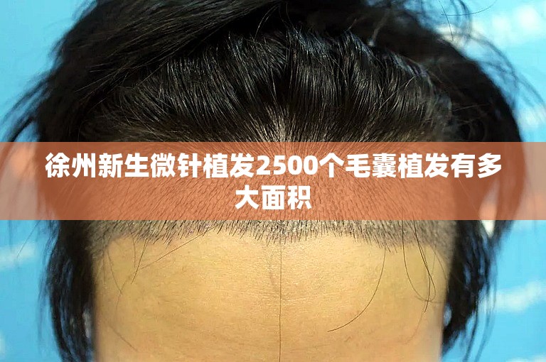 徐州新生微针植发2500个毛囊植发有多大面积