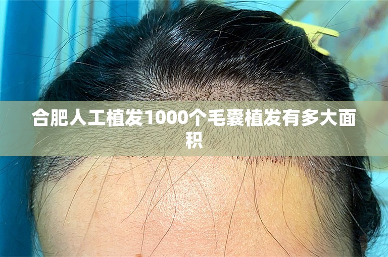 合肥人工植发1000个毛囊植发有多大面积