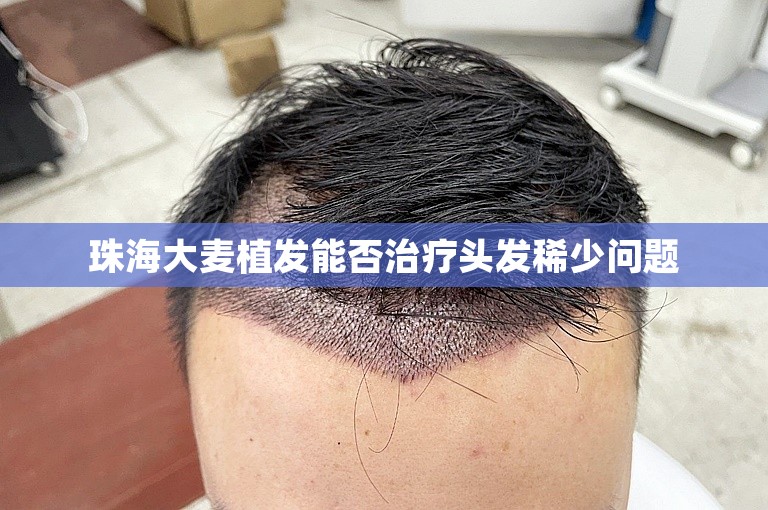 珠海大麦植发能否治疗头发稀少问题
