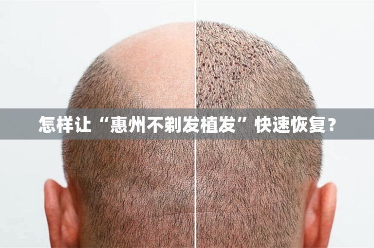 怎样让“惠州不剃发植发”快速恢复？