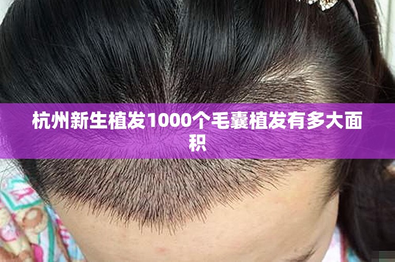 杭州新生植发1000个毛囊植发有多大面积