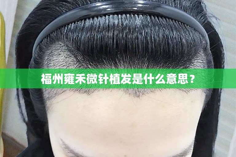 福州雍禾微针植发是什么意思？
