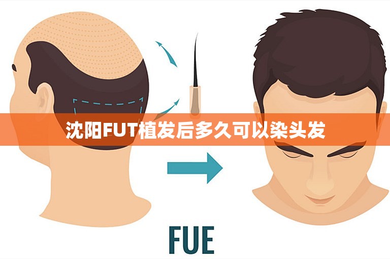 沈阳FUT植发后多久可以染头发