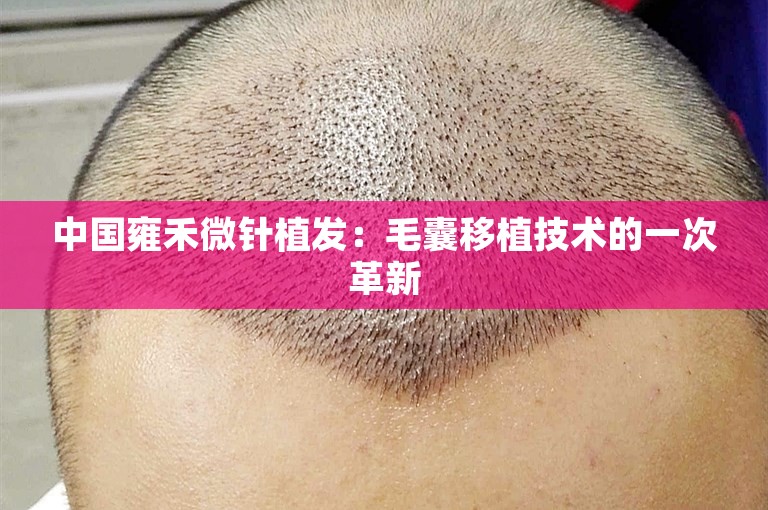 中国雍禾微针植发：毛囊移植技术的一次革新