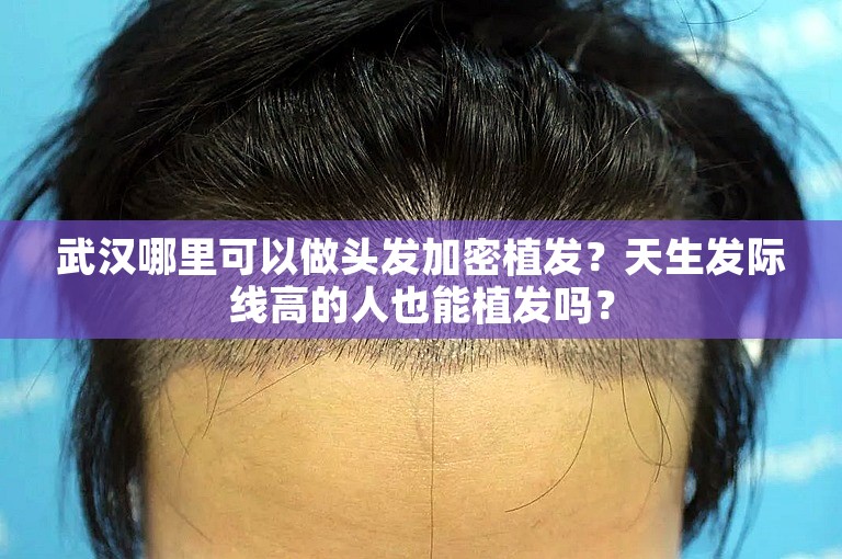 武汉哪里可以做头发加密植发？天生发际线高的人也能植发吗？