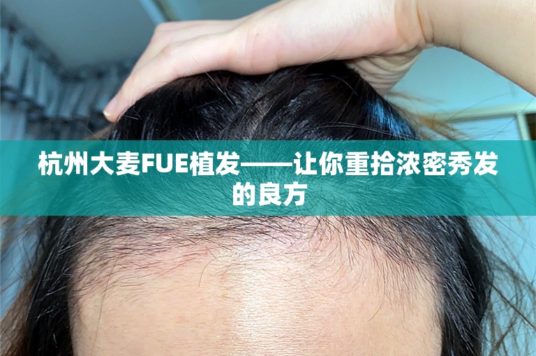 杭州大麦FUE植发——让你重拾浓密秀发的良方