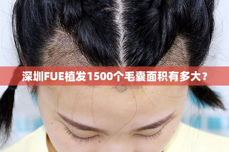 深圳FUE植发1500个毛囊面积有多大？