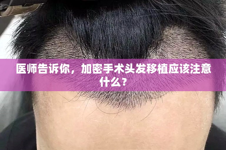 惠州头发种植好点的植发专家选择方案