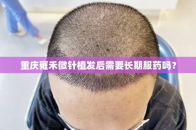 重庆雍禾微针植发后需要长期服药吗？