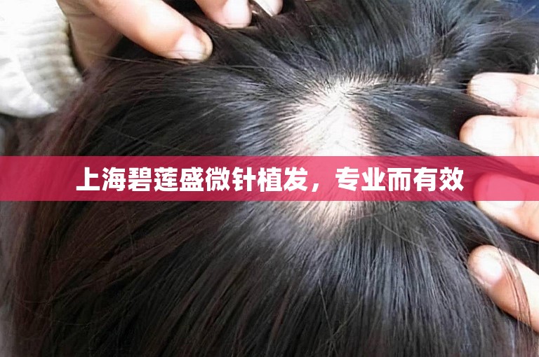 上海碧莲盛微针植发，专业而有效
