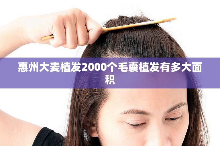 惠州大麦植发2000个毛囊植发有多大面积