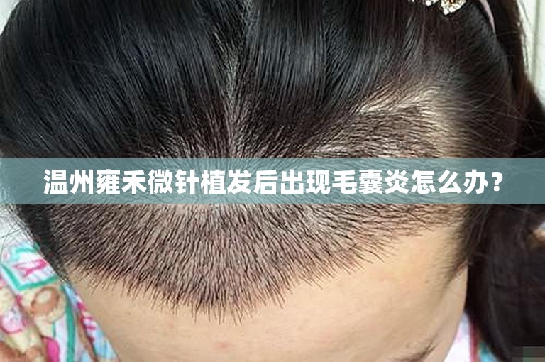 温州雍禾微针植发后出现毛囊炎怎么办？
