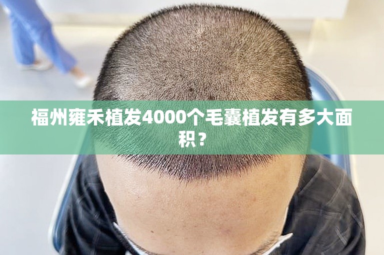 福州雍禾植发4000个毛囊植发有多大面积？