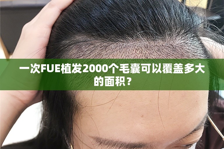 一次FUE植发2000个毛囊可以覆盖多大的面积？