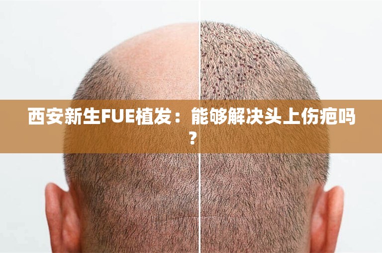 西安新生FUE植发：能够解决头上伤疤吗？