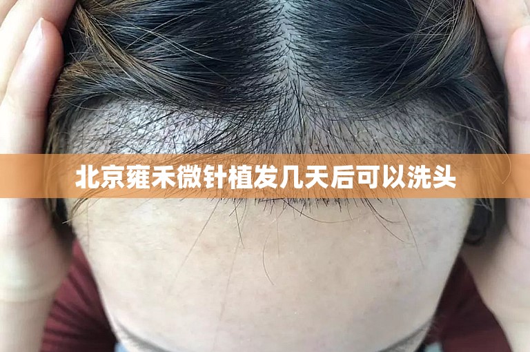 北京雍禾微针植发几天后可以洗头