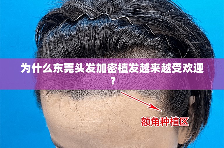 为什么东莞头发加密植发越来越受欢迎？