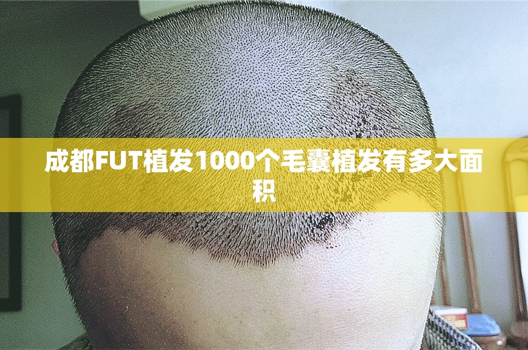 成都FUT植发1000个毛囊植发有多大面积
