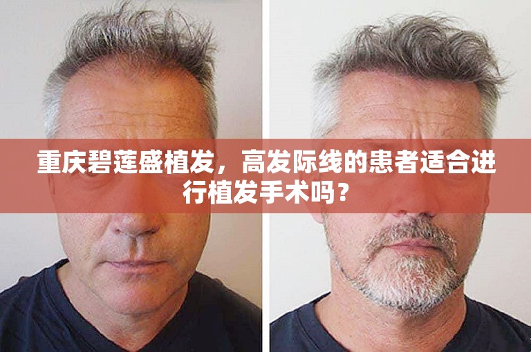 重庆碧莲盛植发，高发际线的患者适合进行植发手术吗？