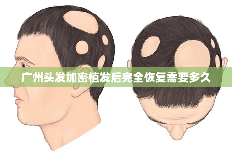 广州头发加密植发后完全恢复需要多久