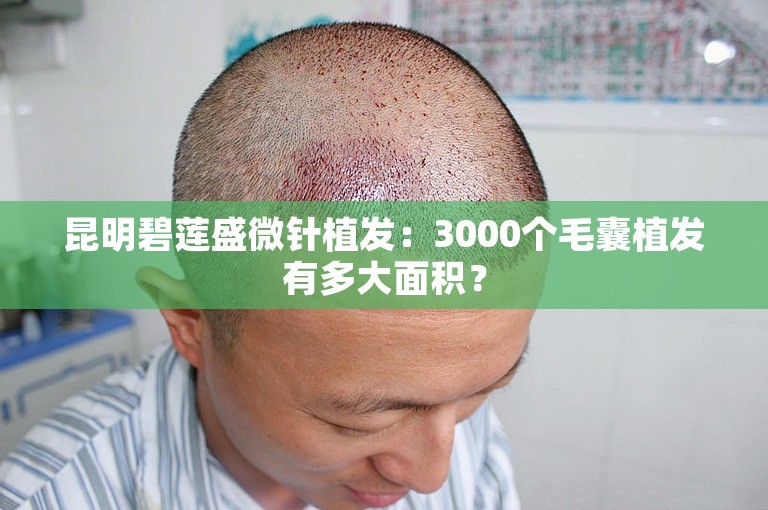 昆明碧莲盛微针植发：3000个毛囊植发有多大面积？