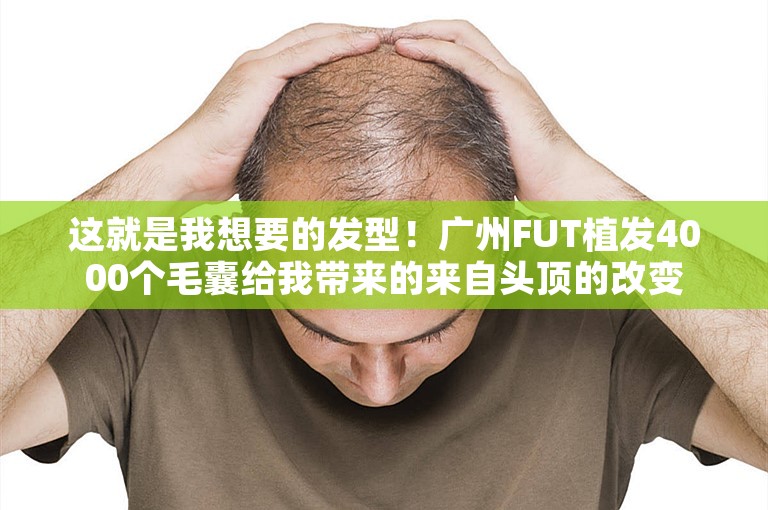 这就是我想要的发型！广州FUT植发4000个毛囊给我带来的来自头顶的改变