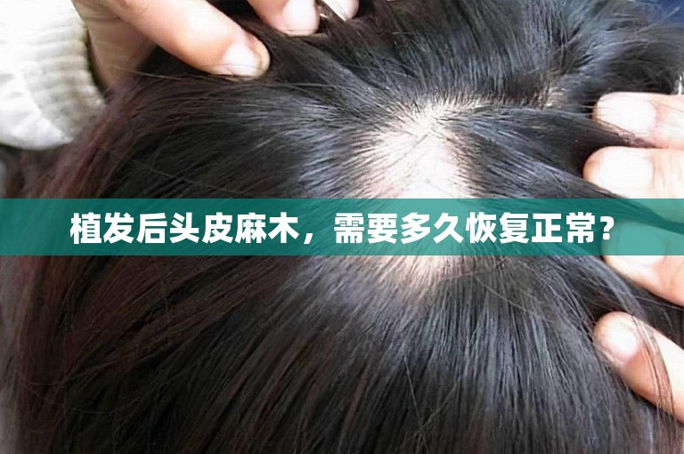 植发后头皮麻木，需要多久恢复正常？