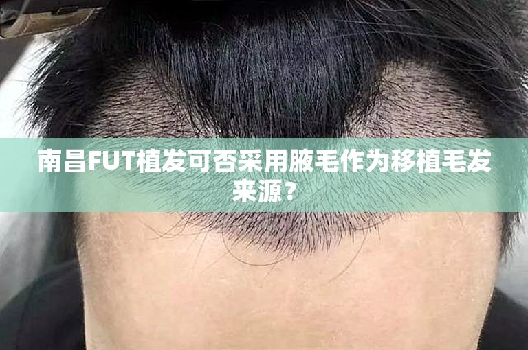 南昌FUT植发可否采用腋毛作为移植毛发来源？