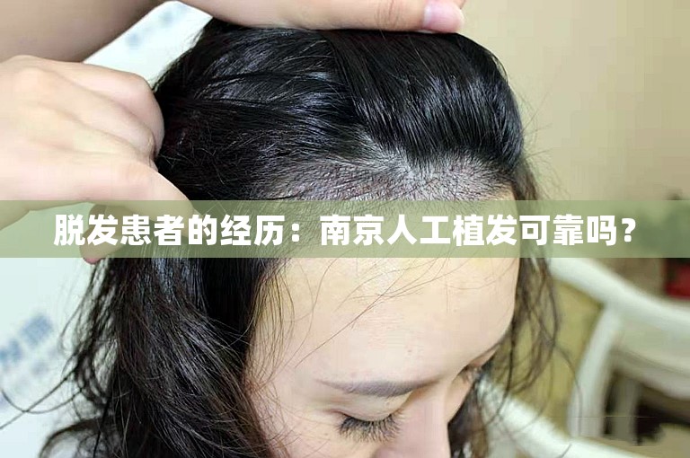 脱发患者的经历：南京人工植发可靠吗？