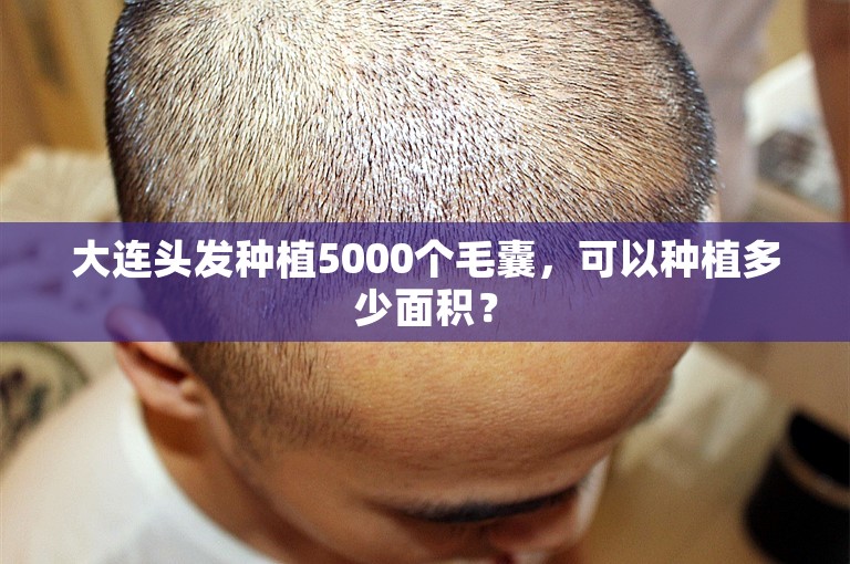 大连头发种植5000个毛囊，可以种植多少面积？