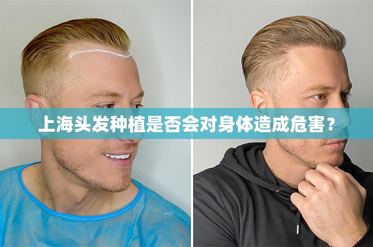 上海头发种植是否会对身体造成危害？