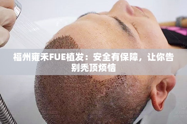 福州雍禾FUE植发：安全有保障，让你告别秃顶烦恼