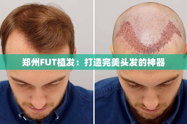 郑州FUT植发：打造完美头发的神器