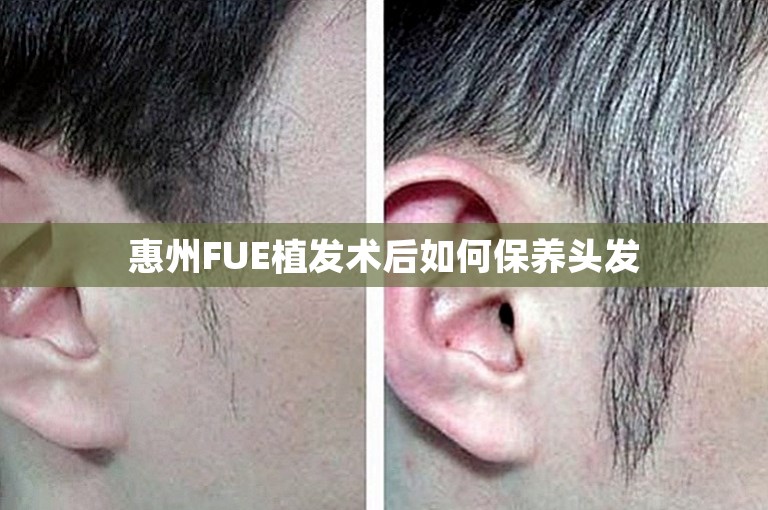 惠州FUE植发术后如何保养头发