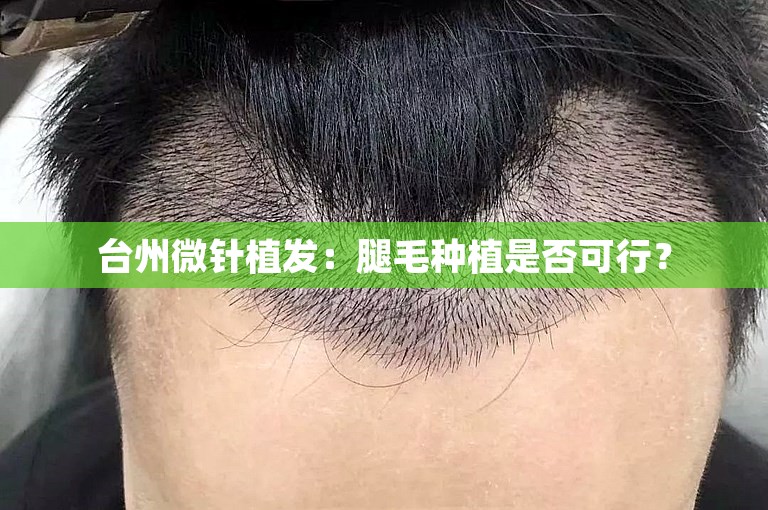 台州微针植发：腿毛种植是否可行？