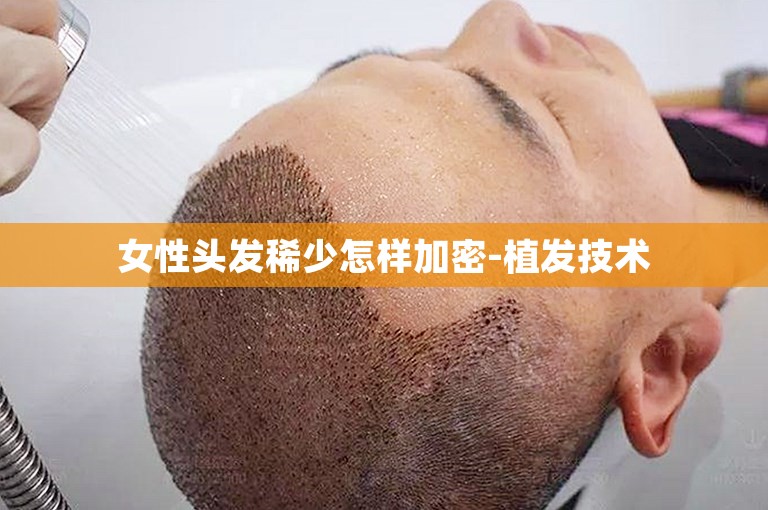 广州最可靠的植发医生怎么选
