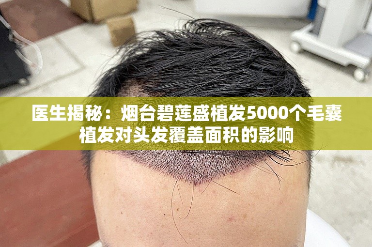 医生揭秘：烟台碧莲盛植发5000个毛囊植发对头发覆盖面积的影响
